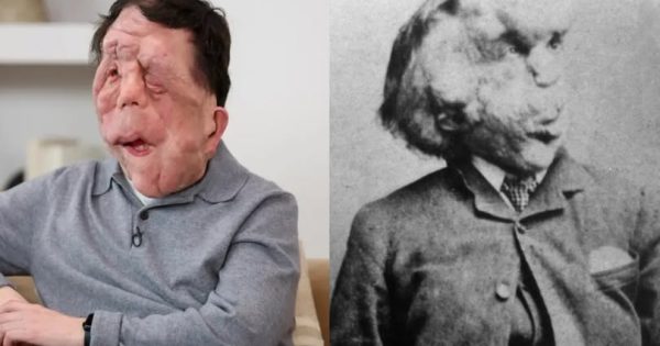 Νέα διασκευή στον «Άνθρωπο Ελέφαντα», ο Άνταμ Πίρσον πρωταγωνιστεί, ο Όλιβερ Χιρσμπίγκελ σκηνοθετεί